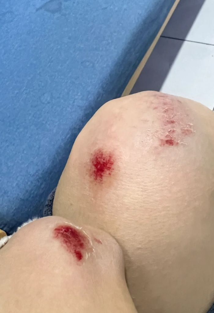 ảnh bị thương xước chân