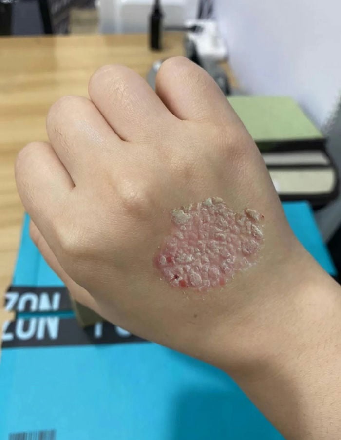 hình ảnh bệnh hắc lào trên da